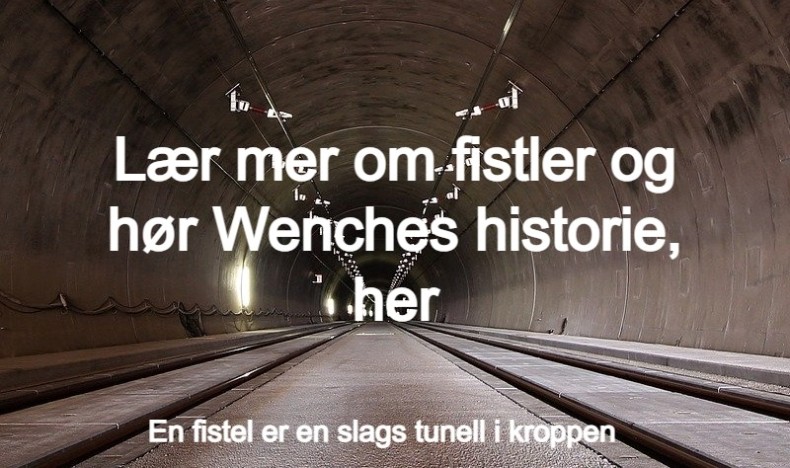 Fistler ved Crohns sykdom